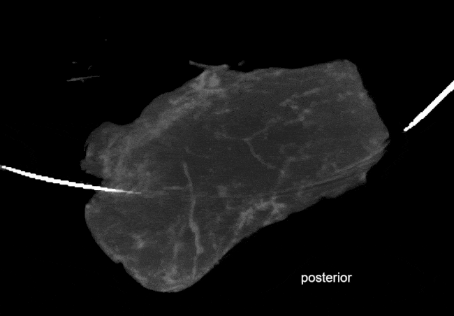 DCIS imaging gif